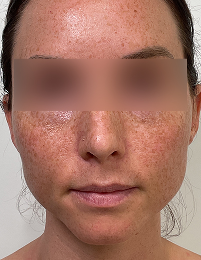 Sculptra — Midface Volume - Before